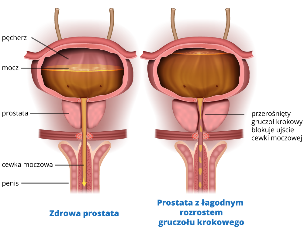 prezerost-prostaty